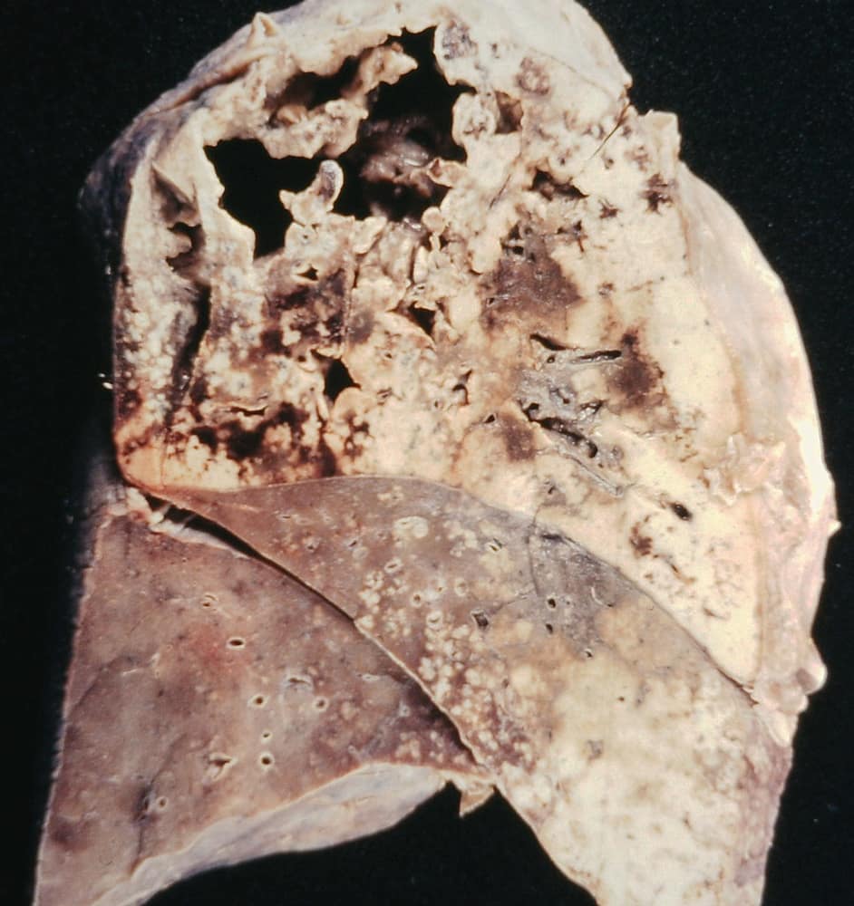 Tuberculosis: The Overlooked Infectious Disease Still Claiming Lives — tuberculosis risk and symptoms