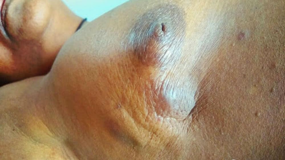 10 Subtle Breast Changes: What to Notice Early On — early signs of breast cancer